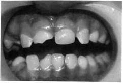 классификация острой травмы зубов 1 страница - student2.ru