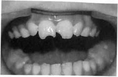 классификация острой травмы зубов 2 страница - student2.ru