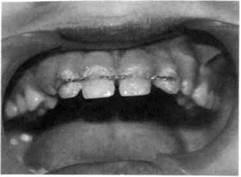 классификация острой травмы зубов 2 страница - student2.ru