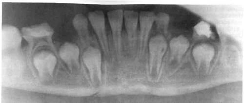классификация острой травмы зубов 4 страница - student2.ru