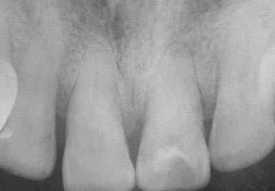 Классификация переломов зуба - student2.ru