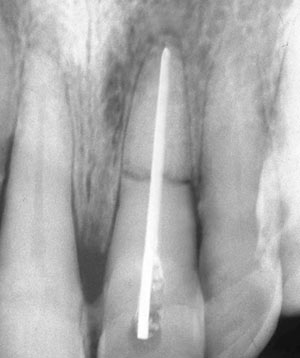 Классификация переломов зуба - student2.ru