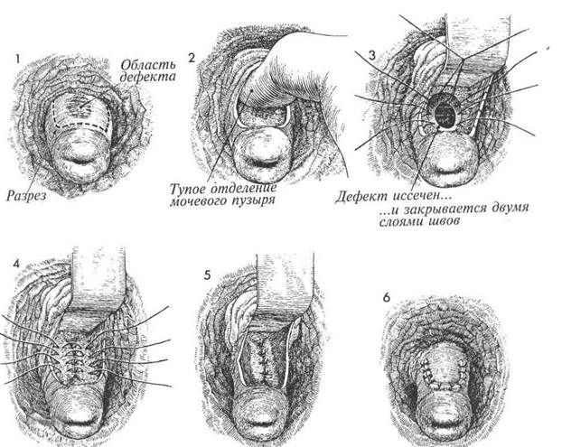 коррекция истмико-цервикальнои недостаточности по lash - student2.ru