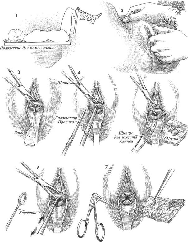 коррекция истмико-цервикальнои недостаточности по lash - student2.ru