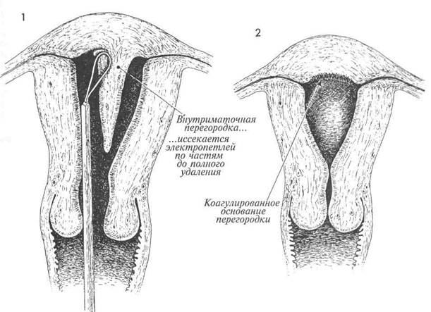 коррекция удвоения матки путем гистероскопического иссечения перегородки - student2.ru