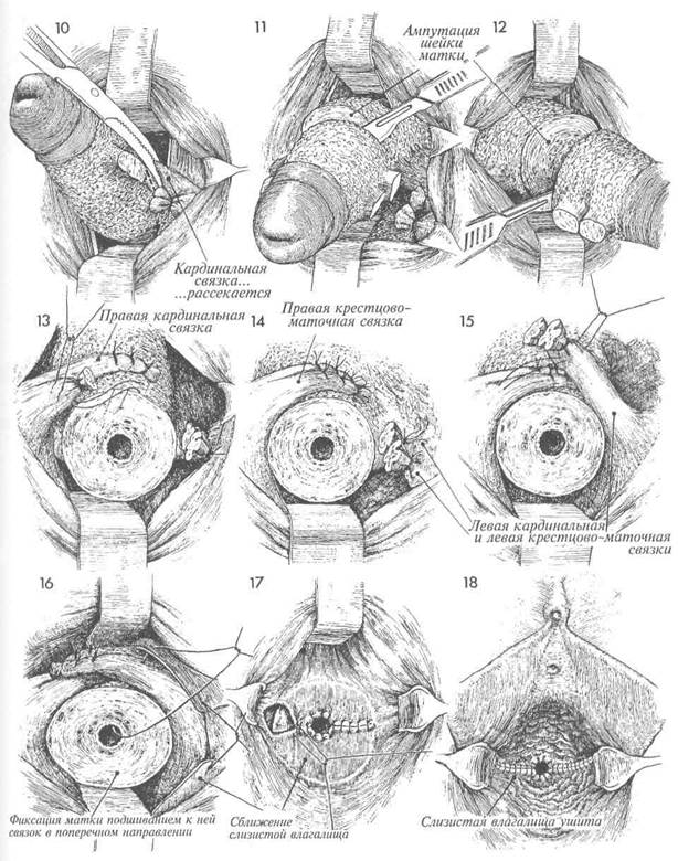 коррекция удвоения матки путем гистероскопического иссечения перегородки - student2.ru