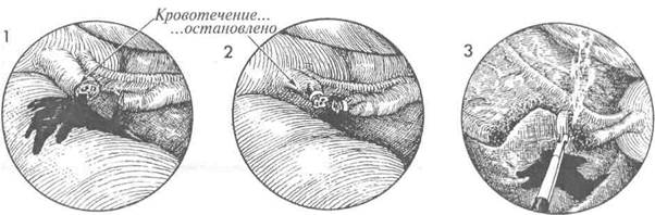 лапароскопическая остановка кровотечения - student2.ru
