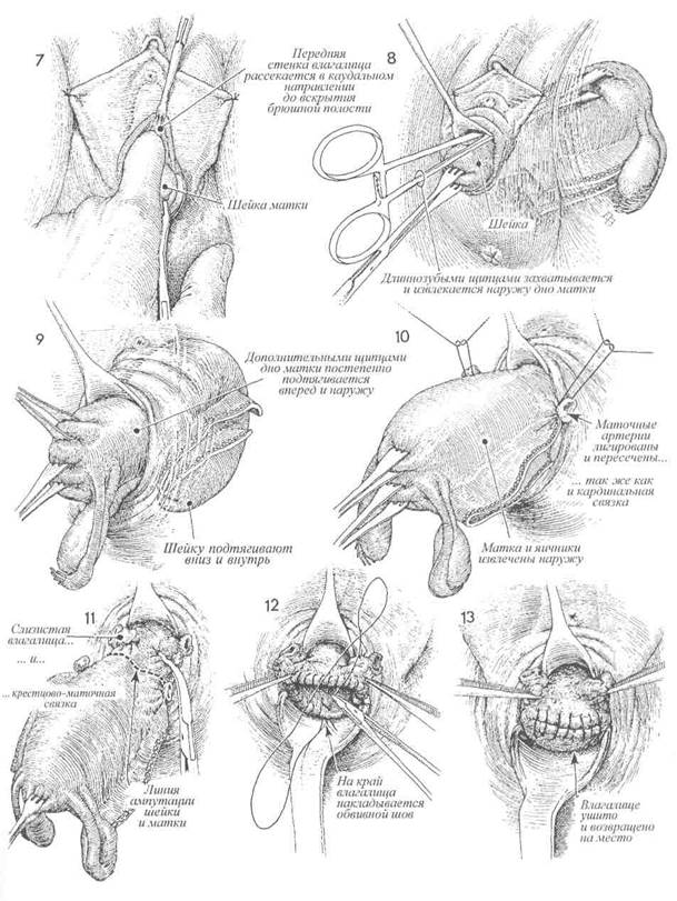 лапароскопическая влагалищная экстирпация матки - student2.ru