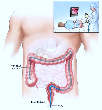 методы диагностики заболеваний прямой кишки - student2.ru