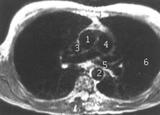 МРТ в исследовании легких и средостения. Магнитно-резонансно-томографическая анатомия легких и средостения - student2.ru
