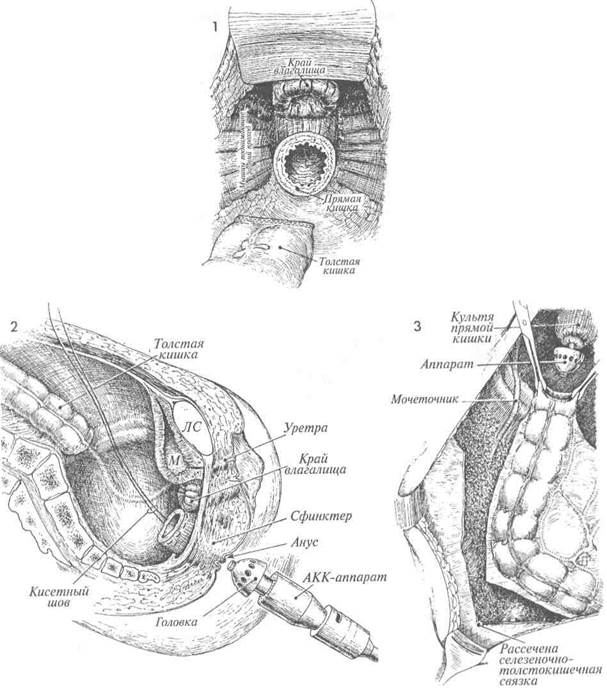 наложение низкого анастомоза между толстой и прямой кишками сшивающим - student2.ru