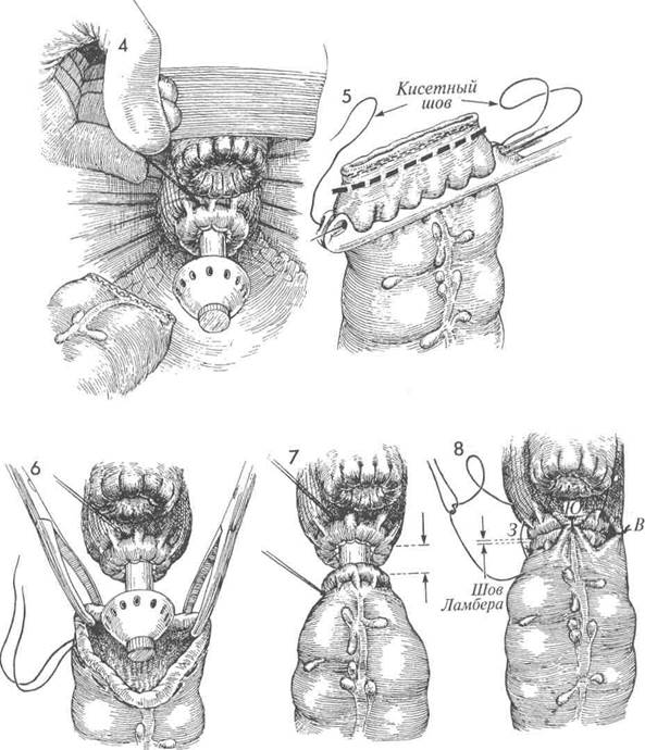 наложение низкого анастомоза между толстой и прямой кишками сшивающим - student2.ru
