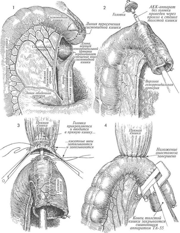 НАЛОЖЕНИЕ НИЗКОГО АНАСТОМОЗА МЕЖДУ ТОЛСТОЙ И ПРЯМОЙ КИШКАМИ СШИВАЮЩИМ. На сагиттальном разрезе показаны соеди­ненные прямая и толстая кишки - student2.ru
