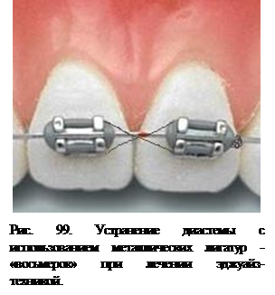 Назовите действующие элементы для поворота 11 зуба при достаточном месте для него в зубном ряду ребенку 8 лет - student2.ru