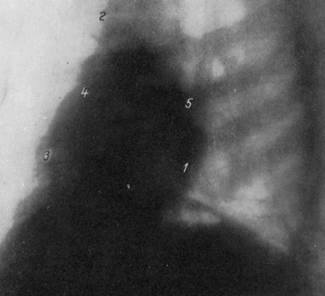 Нормальная рентгеноанатомия сердца. - student2.ru