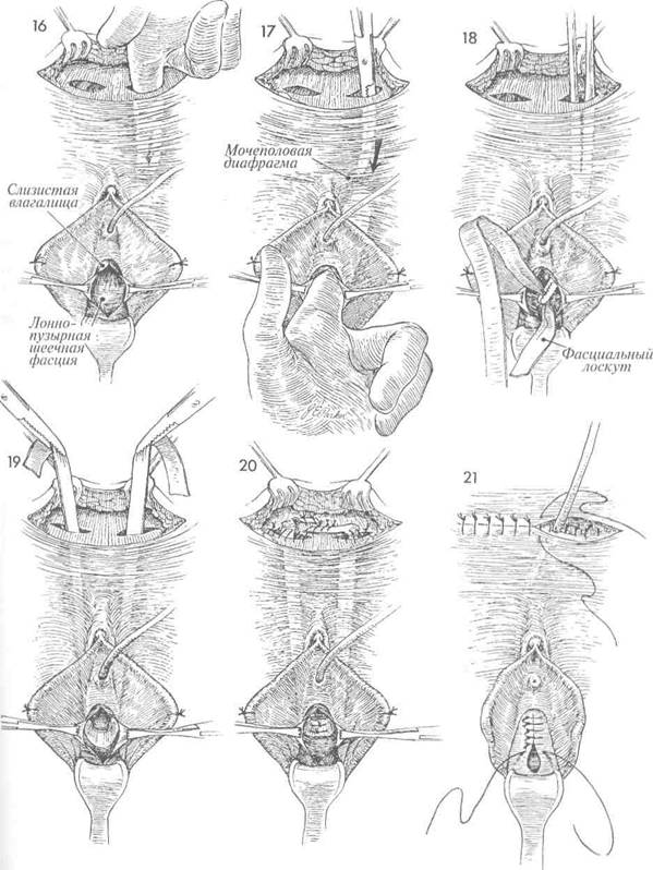 операция с использованием лоскута широкой фасции для лечения недержания мочи по goebell-stoeckel - student2.ru