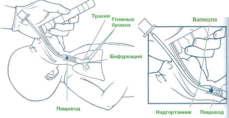Определение размера интубационной трубки - student2.ru