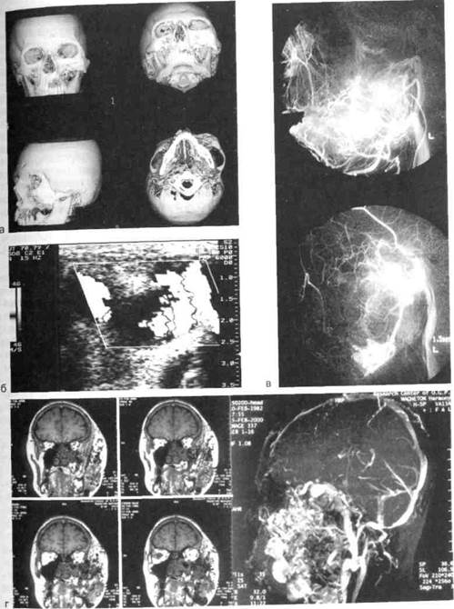 опухоли и опухолеподобные образования мягких тканей и костей лица 3 страница - student2.ru
