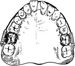 Ортодонтические аппараты механического типа действия. - student2.ru