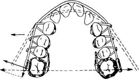 Ортодонтические аппараты механического типа действия. - student2.ru