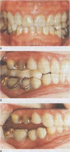 Осложнения при применении накусочных пластинок и окклюзионных шин - student2.ru