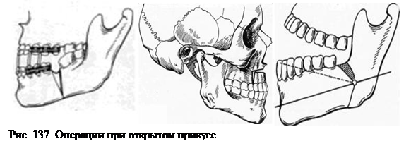 открытый прикус - student2.ru