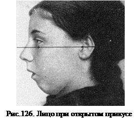 Аденоидное лицо фото. Аденоидный Тип лица окклюзия. Аденоидный Тип лица у детей. Аденоидный Тип лица у взрослых. Аденоидная деформация лица.