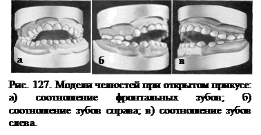 открытый прикус - student2.ru