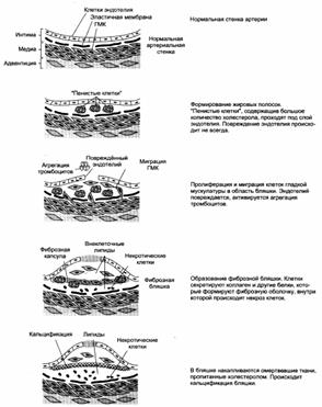 Патологии липидного обмена: атеросклероз, ожирение, жировая дегенарация печени, желчно-каменная болезнь, липидозы. Коэффициент атерогенности. - student2.ru