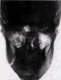 Переломы средней зоны лица у взрослых - student2.ru