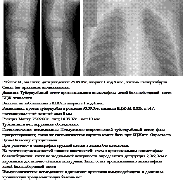переносящих туберкулез в раннем возрасте - student2.ru