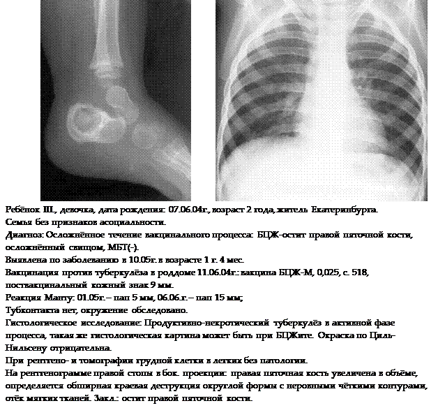 переносящих туберкулез в раннем возрасте - student2.ru