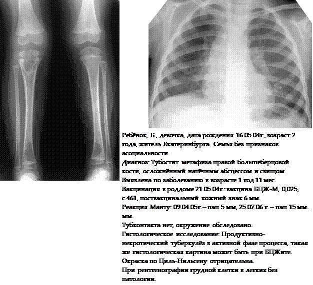 переносящих туберкулез в раннем возрасте - student2.ru