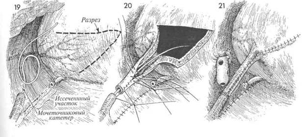пересадка мочеточника в мочевой пузырь с использованием лоскута - student2.ru