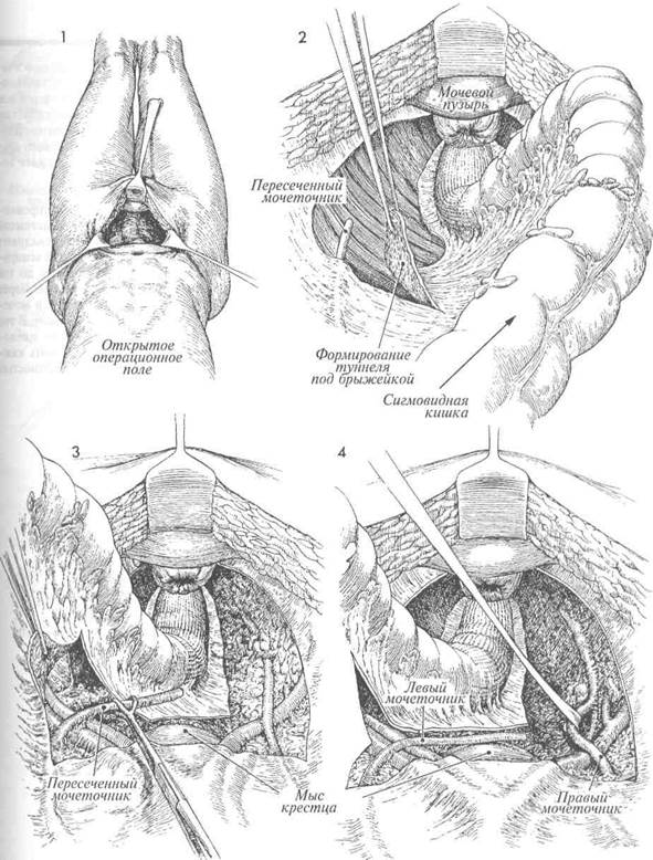 пересадка мочеточника в мочевой пузырь с использованием лоскута - student2.ru