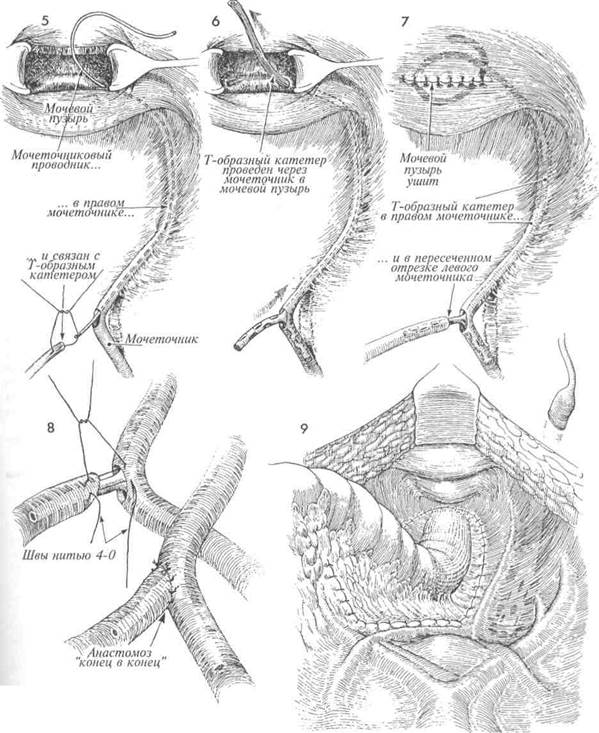 пересадка мочеточника в мочевой пузырь с использованием лоскута - student2.ru