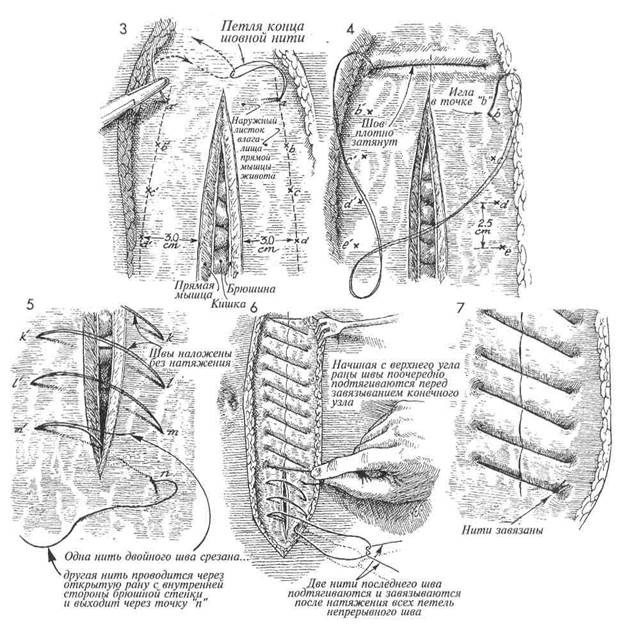 пластика послеоперационных грыж - student2.ru