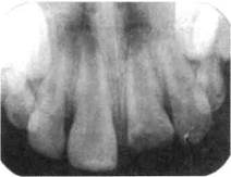 Поражаемость кариесом отдель­ных групп зубов и их поверхностей. 3 страница - student2.ru