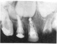 Поражаемость кариесом отдель­ных групп зубов и их поверхностей. 4 страница - student2.ru