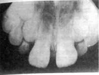 Поражаемость кариесом отдель­ных групп зубов и их поверхностей. 4 страница - student2.ru