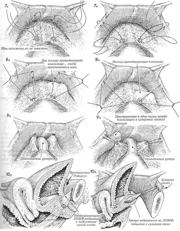 позадилонное подшивание уретры: операции marshall-marchetti-krantz (ммк) и burch - student2.ru