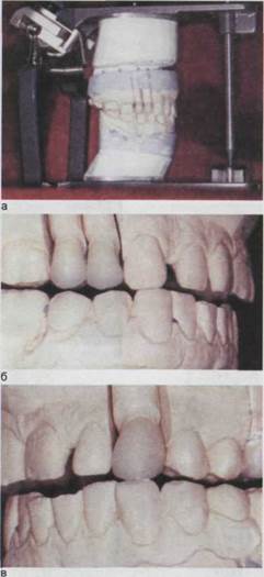 Препарирование зубов с сохранением центрального соотношения челюстей - student2.ru