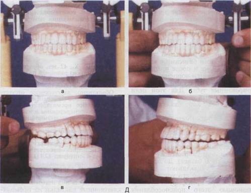 Препарирование зубов с сохранением центрального соотношения челюстей - student2.ru
