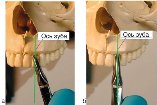 Признак угла у щипцов для удаления зубов: 1-3 - верхней челюсти; 4 - нижней челюсти - student2.ru
