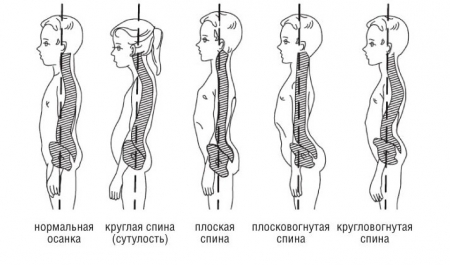 Развитие и лечение сколиоза у детей - student2.ru