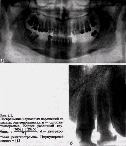 рентгенологическое исследование при кариесе, некариозньгх болезнях и травмах твердых тканей зубов, поражениях пульпы и верхушечном периодонтите, аномалиях и пороках развития зубов - student2.ru