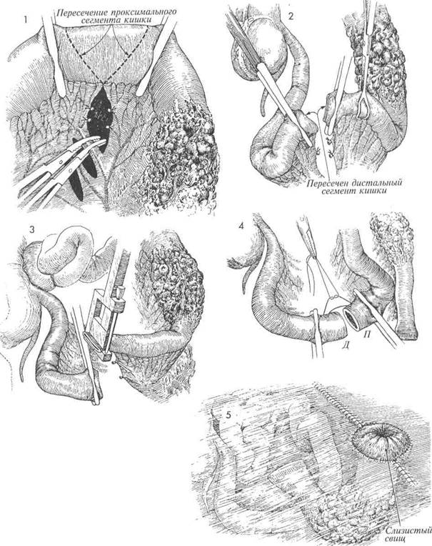 резекция тонкой кишки с наложением анастомоза «конец в конец» пo gambee - student2.ru