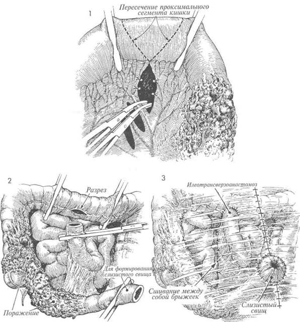 резекция тонкой кишки с наложением анастомоза «конец в конец» пo gambee - student2.ru
