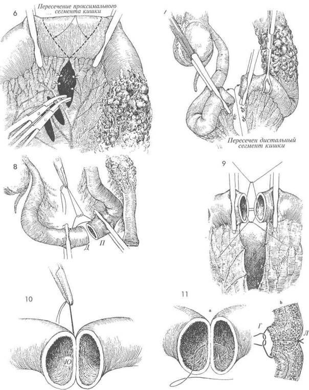 резекция тонкой кишки с наложением анастомоза «конец в конец» пo gambee - student2.ru