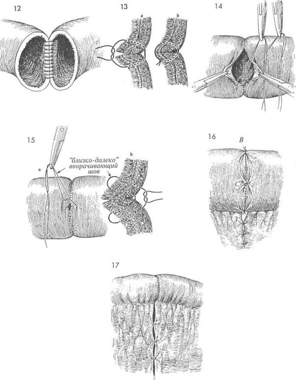 резекция тонкой кишки с наложением анастомоза «конец в конец» пo gambee - student2.ru